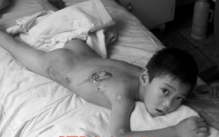 玉米男孩儿的背部图片，玉米男孩满身虫卵图片